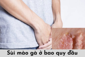 Dịch Vụ Chữa Sùi Mào Gà Ở Vinh Nghệ An Uy Tín, Bảo Mật & Chữa Khỏi 4