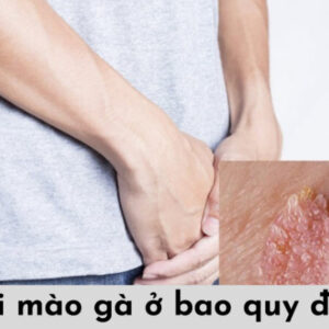 Dịch Vụ Chữa Sùi Mào Gà Ở Vinh Nghệ An Uy Tín, Bảo Mật & Chữa Khỏi 4