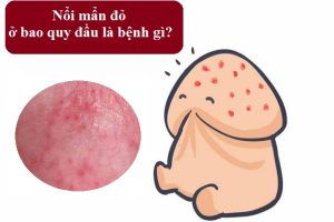 Bao Quy Đầu Nổi Mụn Là Bị Gì? Có Nguy Hiểm Không?