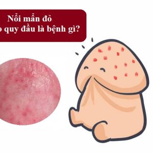 Bao Quy Đầu Nổi Mụn Là Bị Gì? Có Nguy Hiểm Không?