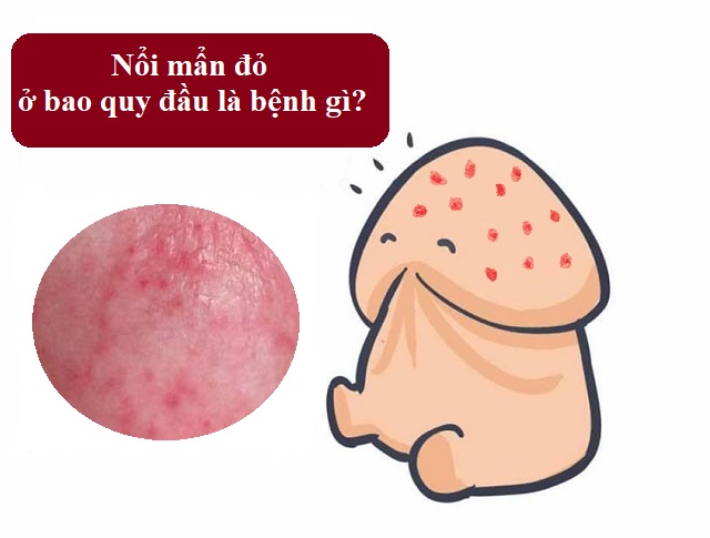 Bao Quy Đầu Nổi Mụn Là Bị Gì? Có Nguy Hiểm Không?