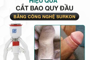 25 Tuổi Cắt Bao Quy Đầu Được Không? Khi Nào Nên Cắt BQĐ? 1