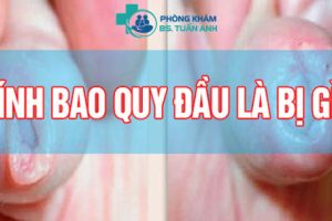 Bao Quy Đầu Dính Vào Dương Vật Là Bị Bệnh Gì? Nên Xử Lý Thế Nào? 1