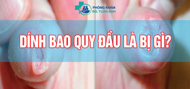 Bao Quy Đầu Dính Vào Dương Vật Là Bị Bệnh Gì? Nên Xử Lý Thế Nào? 1