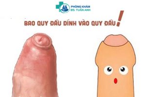 Cắt Bao Quy Đầu Có Tăng Thời Gian Quan Hệ Không? Khi Nào Nên Cắt BQĐ? 3