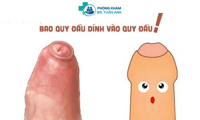 Bao Quy Đầu Dính Vào Dương Vật Là Bị Bệnh Gì? Nên Xử Lý Thế Nào? 2